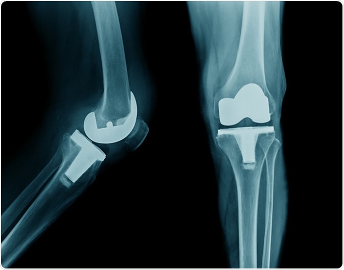 Hip and Knee Implants Market-014da50a