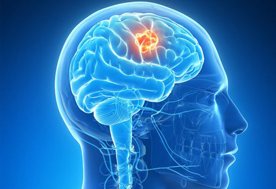 Neurovascular Devices Market-41ad844e